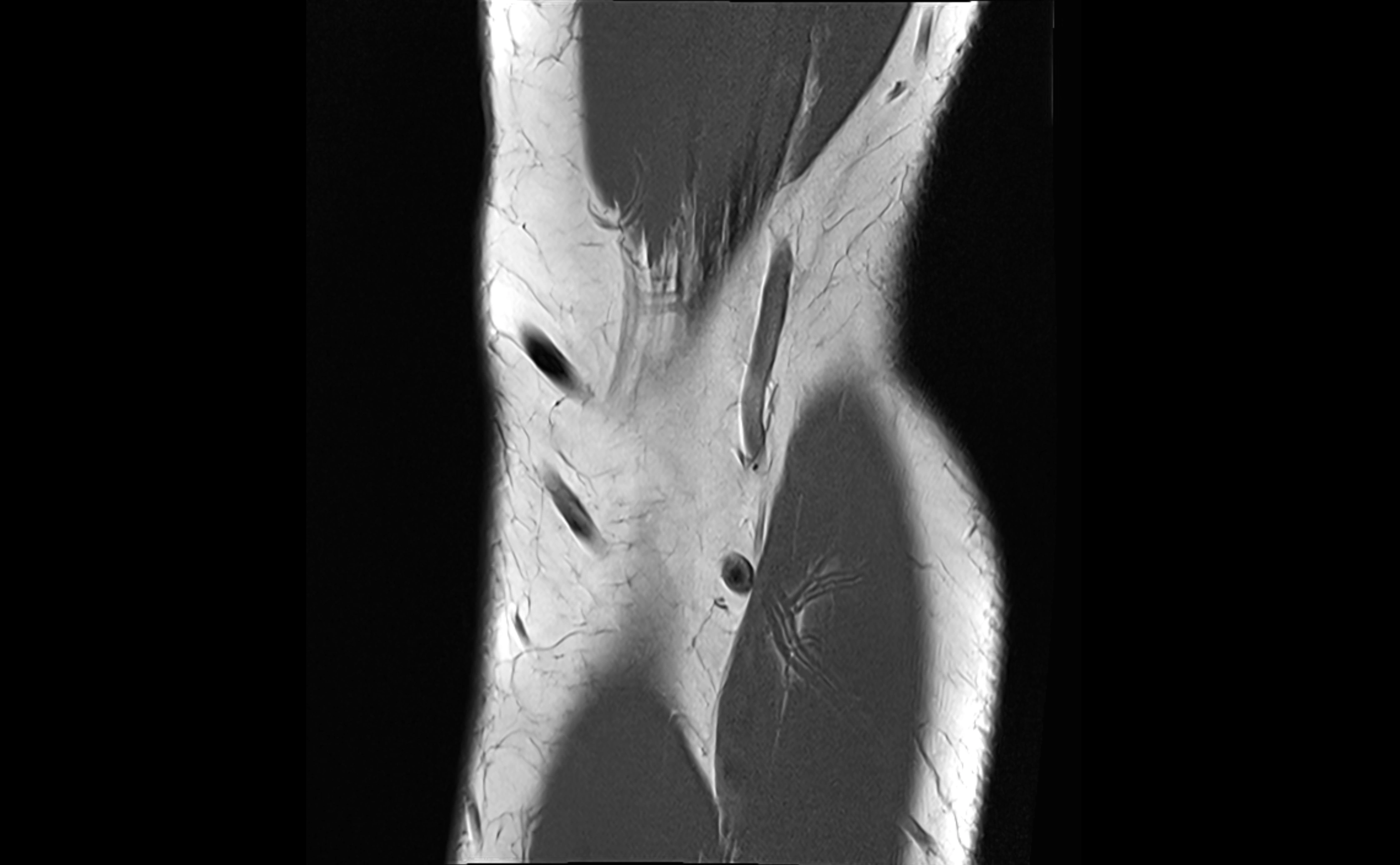 MRI elbow ligaments coronal cross sectional anatomy 3T  radiology  image-img-07001-00006.webp